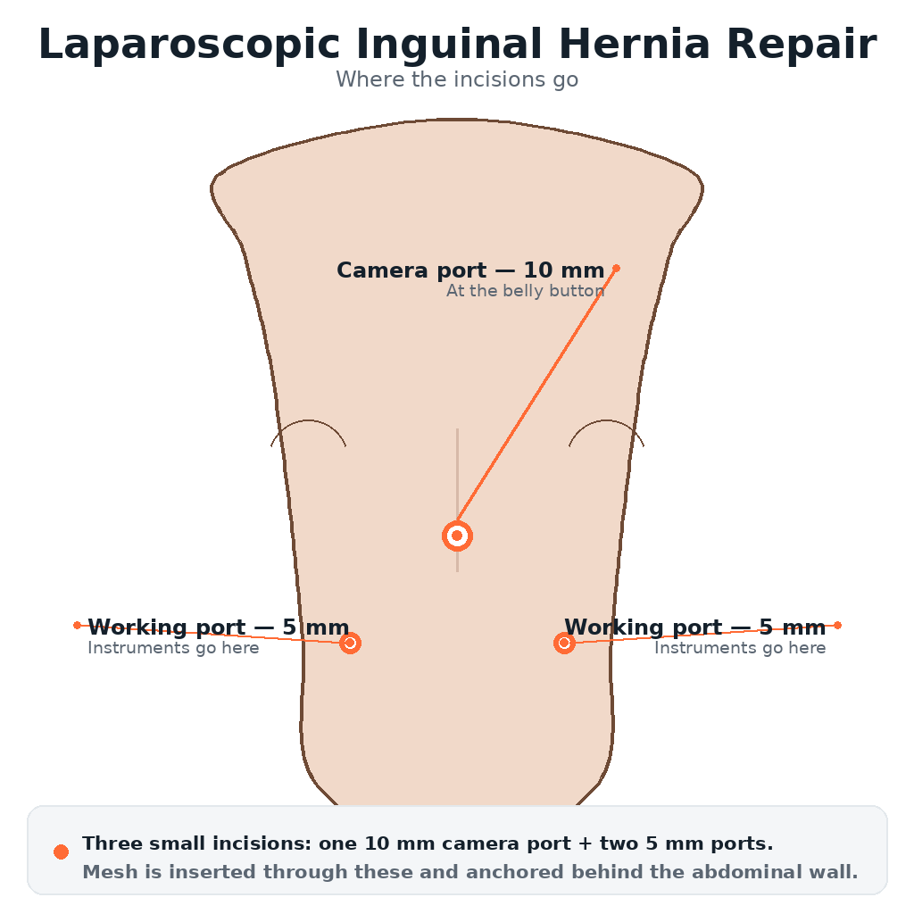 Hernia & Laparoscopic Mesh Surgery: What It Is, Why You Got It, and What Happens Next
